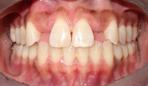 dental implants - before photo