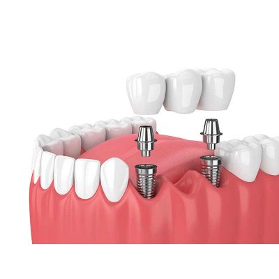 dental bridge on implant)